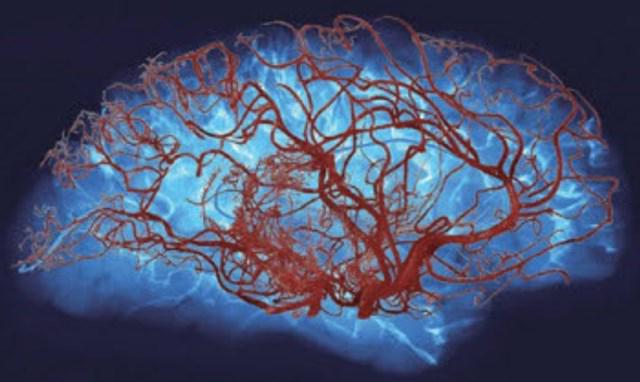 angioencefalopatía pronóstico cerebral