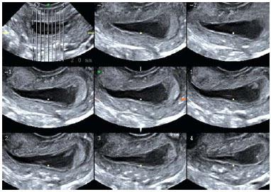 Endometrio por el día del ciclo dentro de los límites de la norma y en caso de desviación de la misma