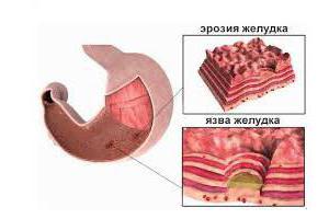 código de gastritis erosiva de microbial 10