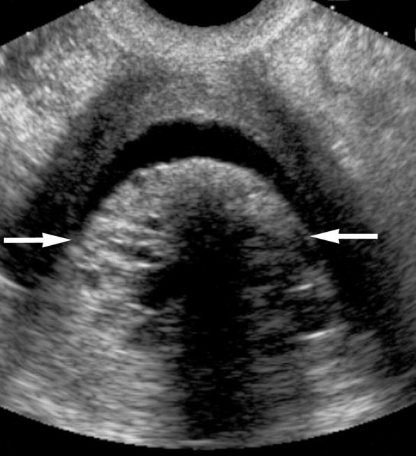 ¿Cuándo y cómo se realiza la biopsia endometrial?