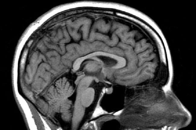 tomografía computarizada o mrt que es mejor para el cerebro