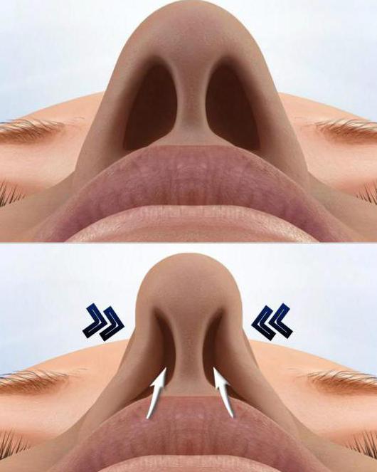 perforación del tabique nasal