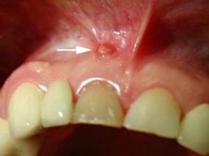 Información útil: alveolitis después de la extracción dental