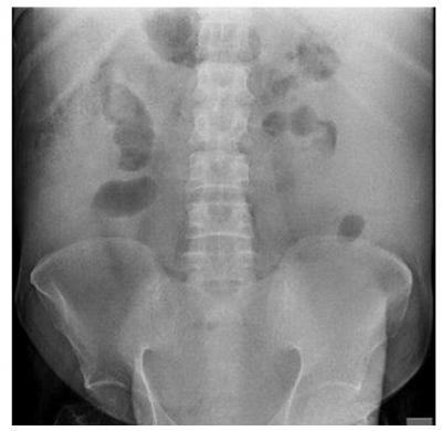 hernia de la pared abdominal anterior abdominal