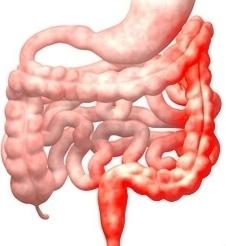 Enfermedad de Crohn colitis ulcerosa