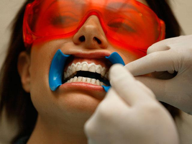 Procedimiento de blanqueamiento dental: opiniones y recomendaciones