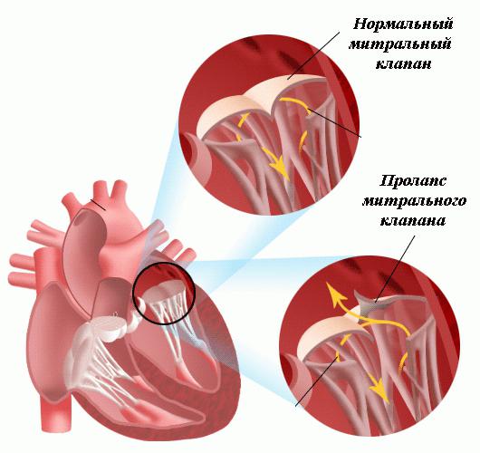 síntomas de prolapso de la válvula mitral