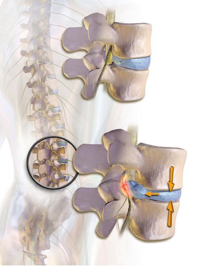 cómo tratar la protrusión de los discos de la columna vertebral