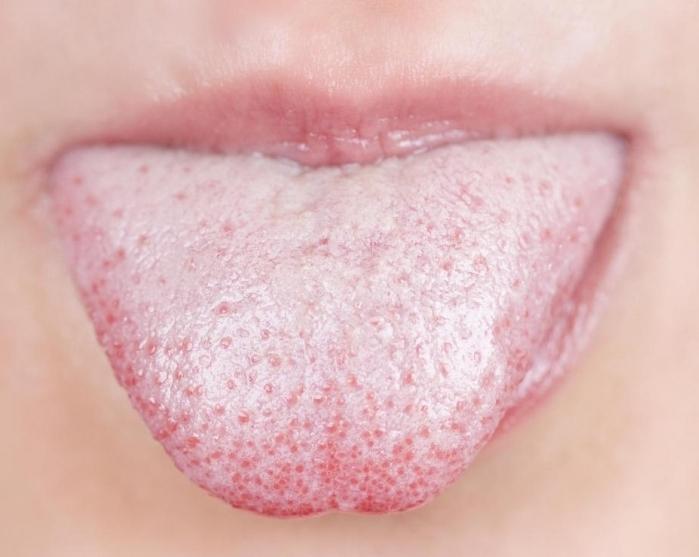  la lengua está cubierta con una flor blanca