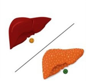 Enfermedad de la cirrosis hepática: cuántos viven con ella